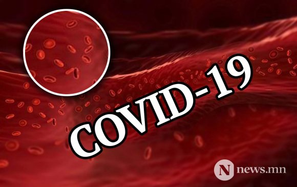 Covid-19 амьсгалын замын биш цусны судасны өвчин байж магадгүй