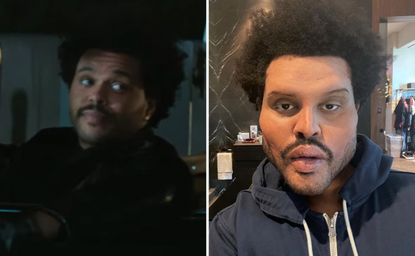 “The Weeknd” гоо сайхны мэс засал хийлгэсэн үү?